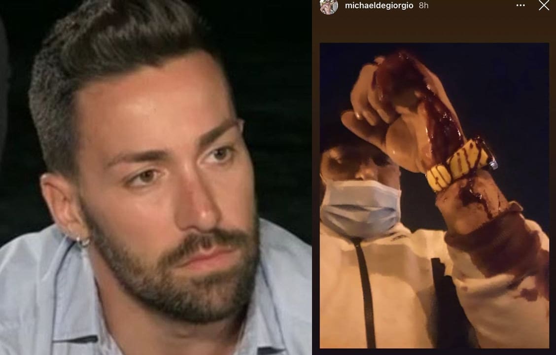 Ex di Temptation Island aggredito e ferito dalla fidanzata: ‘Voleva ucciderlo’