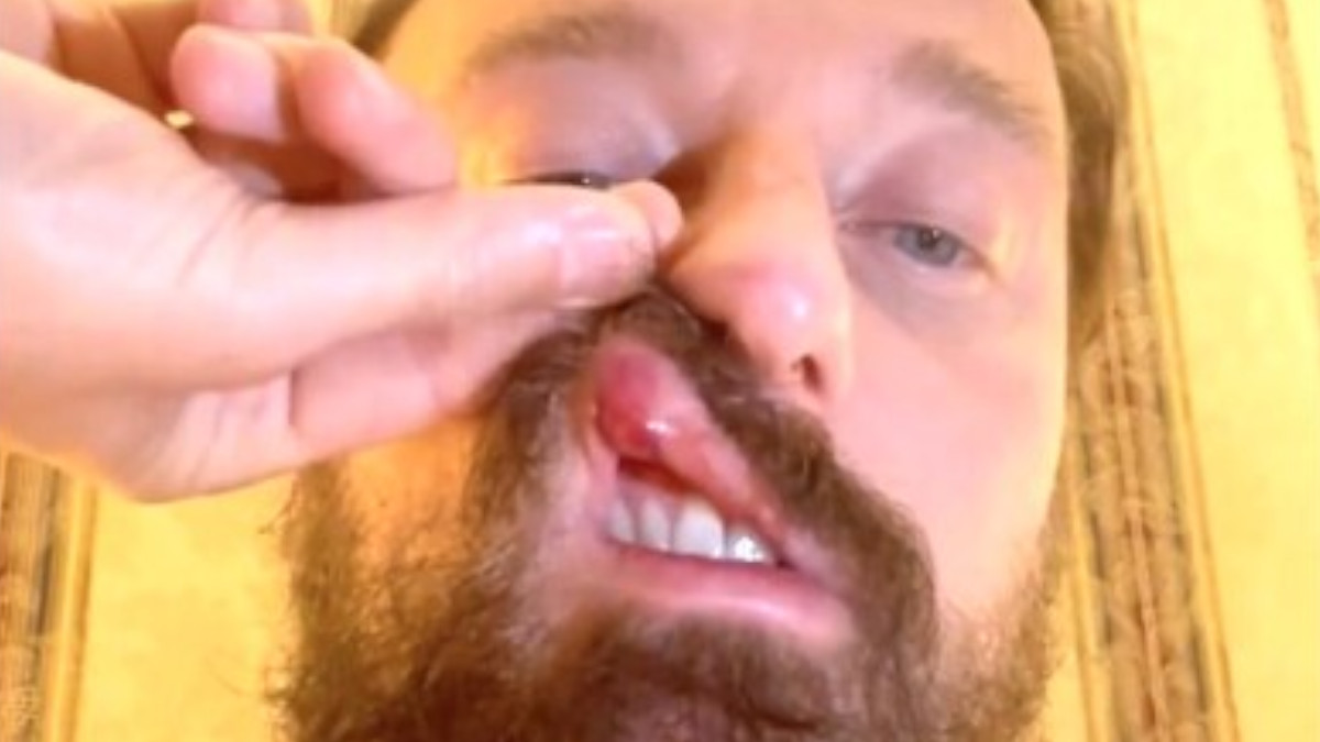 Francesco Facchinetti aggredito: “Conor McGregor mi ha picchiato”. Come sta ora Francesco Facchinetti aggredito: “Conor McGregor mi ha picchiato”. Come sta ora